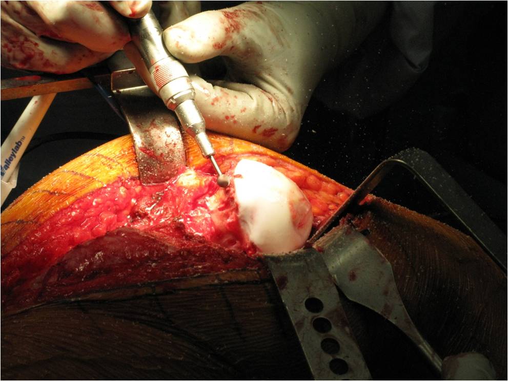 Intra Op PAO and surgical dislocation for a “Perthes” deformity in a 16 year old soccer athlete