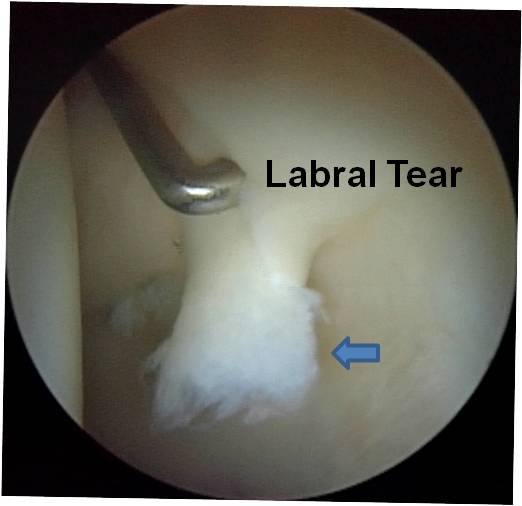 Intra OP PAO to treat a 29 year old female with hip dysplasia and a failed previous hip arthroscopy