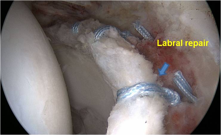 Labral Repair Hip arthroscopy for an 18 year old male baseball player with FAI