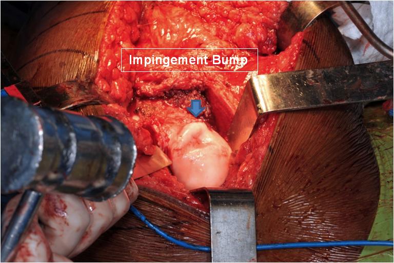 OR Surgical dislocation and proximal femoral osteotomy for a 12 year old female with pain after slipped capital femoral epiphysis (SCFE)