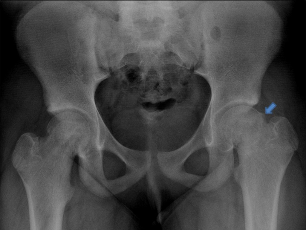 epiphysis of neck of femur