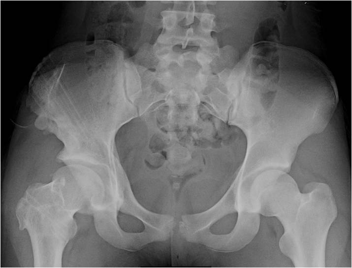 Post Hardware removal PAO and surgical dislocation for a “Perthes” deformity in a 16 year old soccer athlete