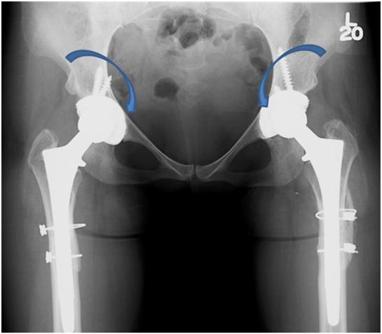 hip-dysplasia-in-humans-symptoms-5dpo-thigh-pain-2-years-after-hip