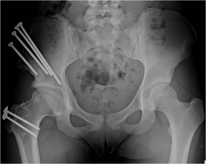 Post OP AP PAO and surgical dislocation for a “Perthes” deformity in a 16 year old soccer athlete