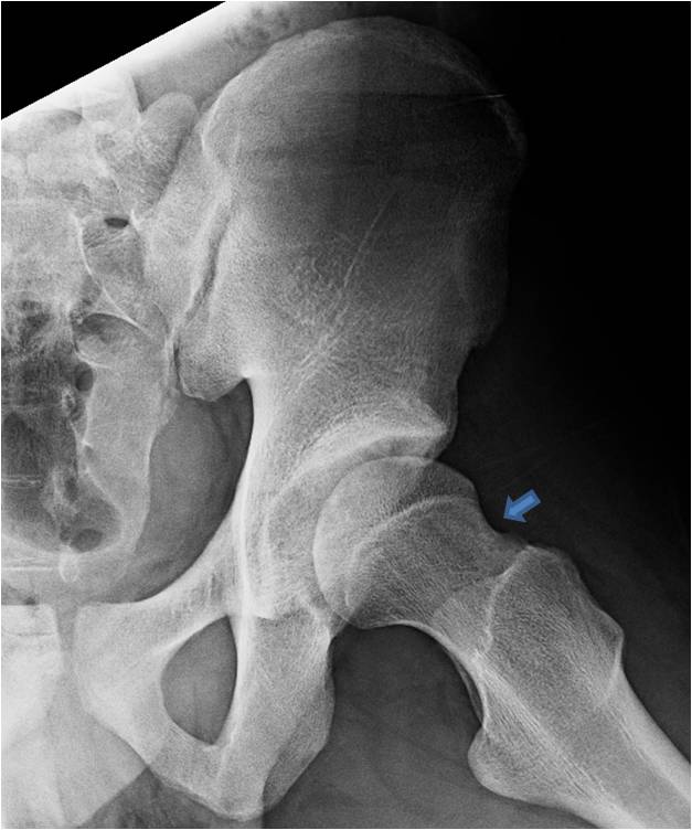 Hip Arthroscopy St. Louis, MO Open Hip Dislocation