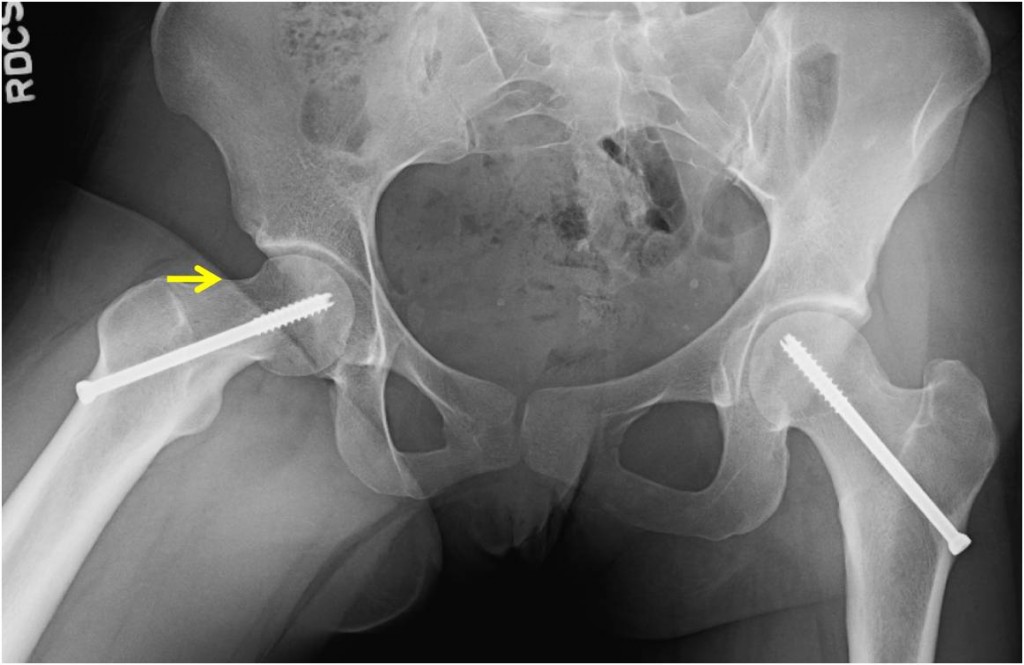 Hip Arthroscopy St. Louis, MO Failed Total Hip