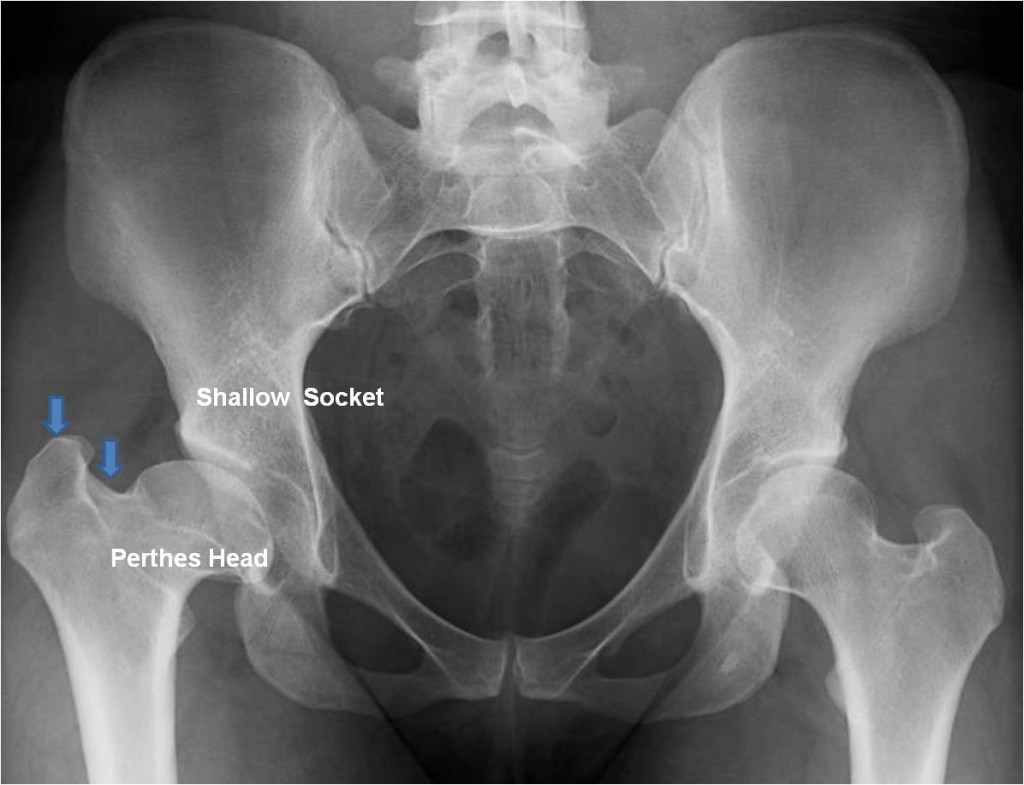 Pre AP PAO and surgical dislocation for a “Perthes” deformity in a 29 year old female