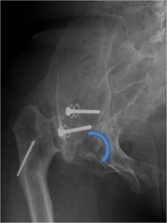 Pre AP cropped Complex total hip replacement in a 23 year old female with a severe pelvic deformity