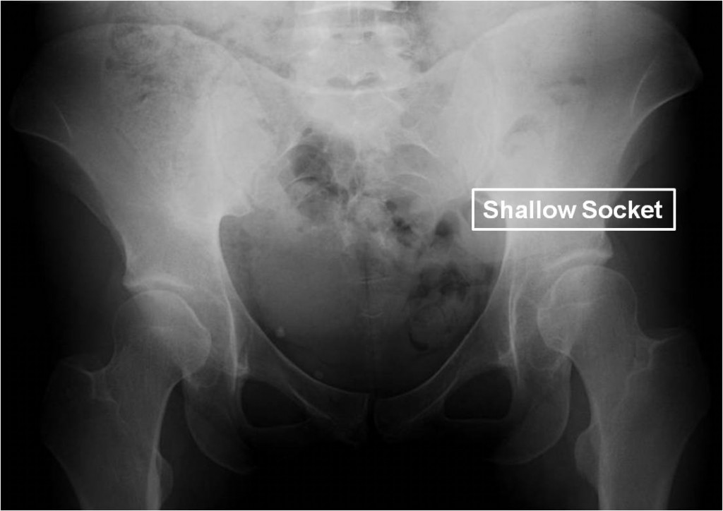 Pre OP PAO to treat a 29 year old female with hip dysplasia and a failed previous hip arthroscopy