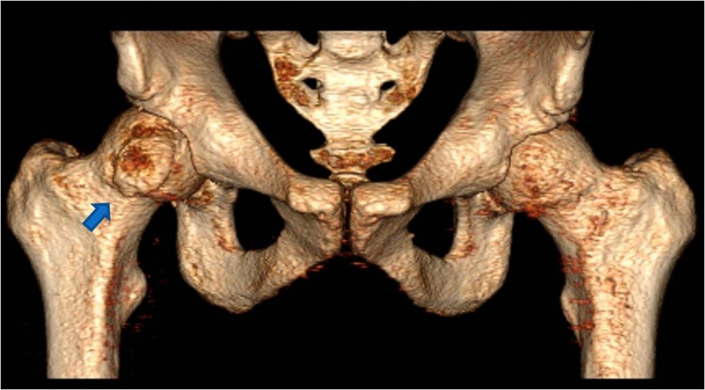 Pre OP Surgical dislocation for FAI after femoral head fracture malunion in an active young male