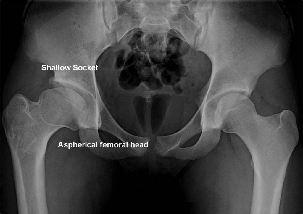 Pre OP AP PAO and surgical dislocation for a “Perthes” deformity in a 16 year old soccer athlete