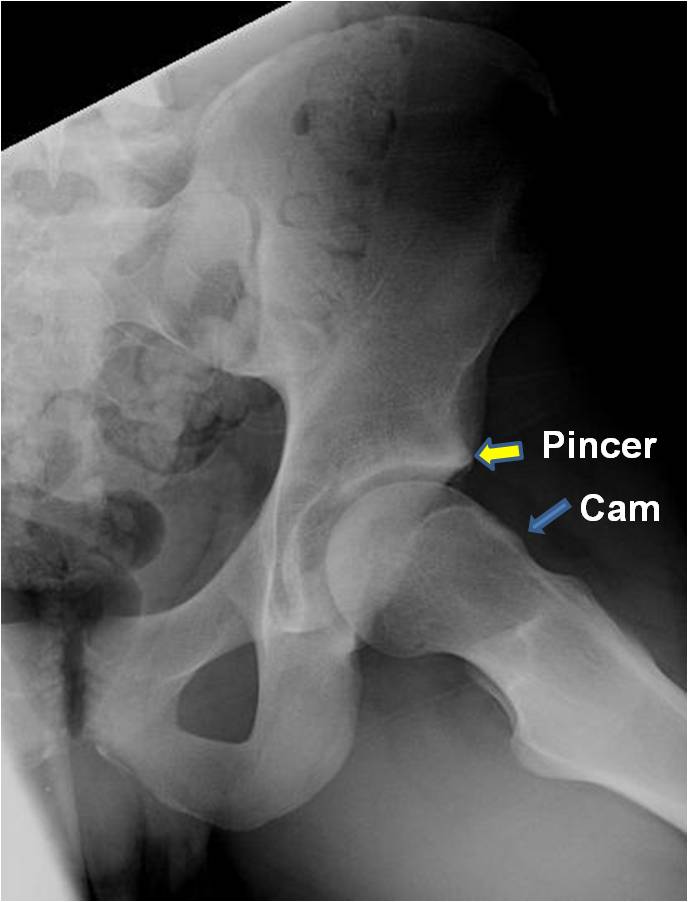 Hip Impingement / FAI / AIS Mobilization and