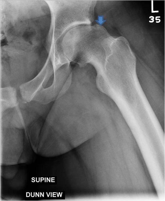 Pre OP Surgical dislocation and proximal femoral osteotomy in an 18 year old male with severe residual SCFE deformity