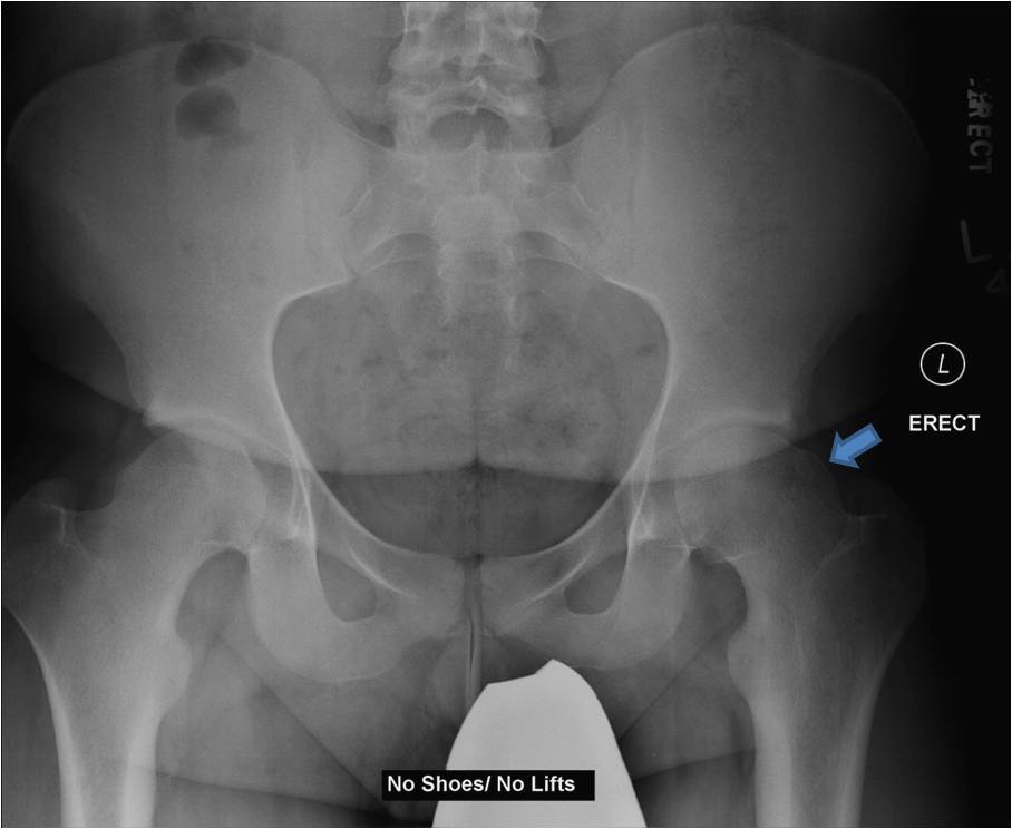 Pre OP Surgical dislocation and proximal femoral osteotomy in an 18 year old male with severe residual SCFE deformity