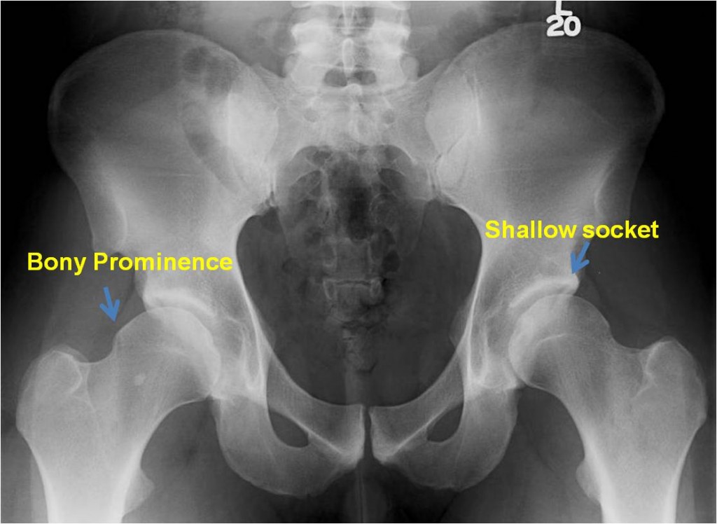 Acetabular Dysplasia