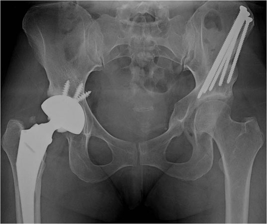 Hip dysplasia in 37-year-old post-op