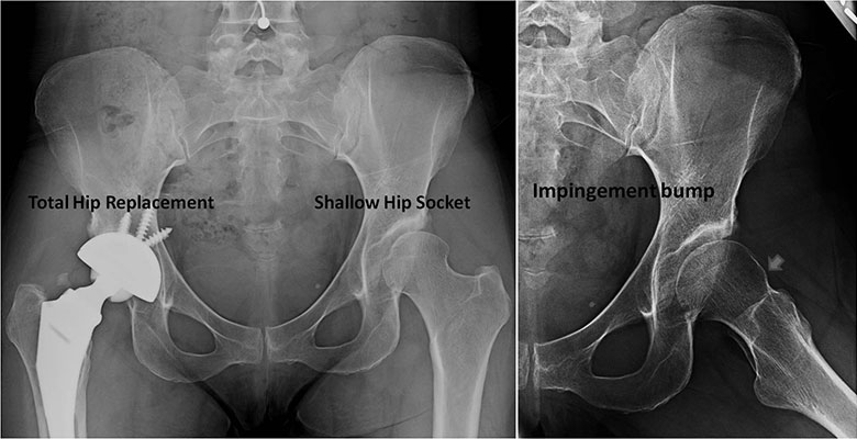 Hip dysplasia in 37-year-old pre-op