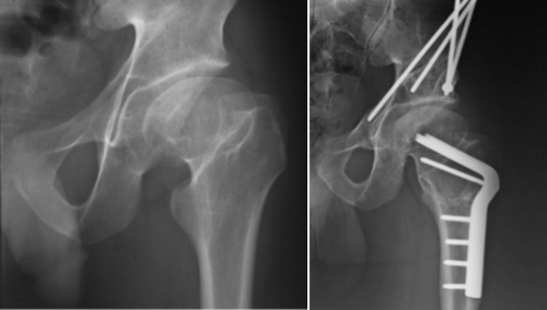 Perthes disease pre-op and post-op PAO surgery, periacetabular osteotomy