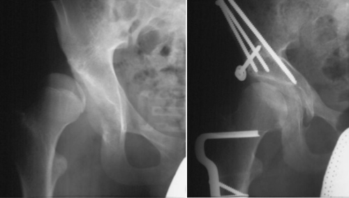 Severe acetabular dysplasia and nine years after periacetabular osteotomy
