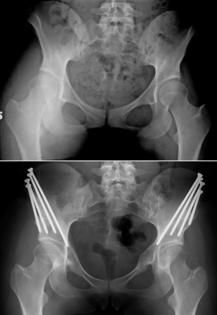 hip replacement St. Louis, MO | Slipped capital femoral epiphysis