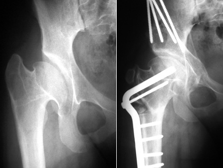 X-rays of a 13-year-old girl with severe Perthes deformity