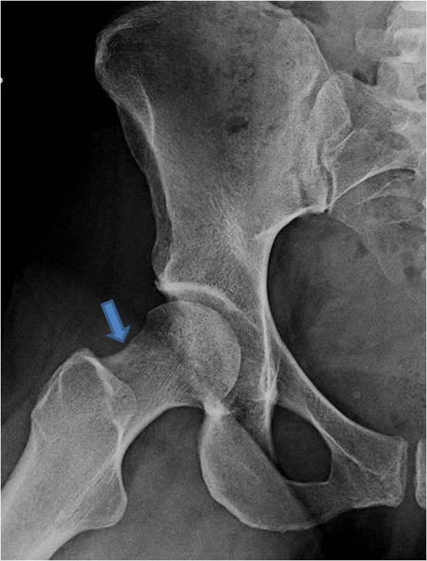 Post Op Frog Hip arthroscopy to treat FAI in a female dance instructor