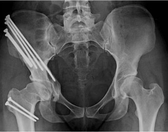 Post OP AP PAO and surgical dislocation for a “Perthes” deformity in a 29 year old female